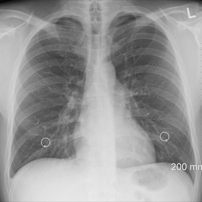 أشعة عادية X-Ray